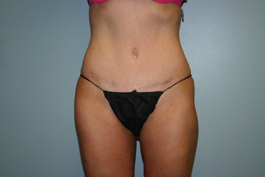 Tummy Tuck Before & After