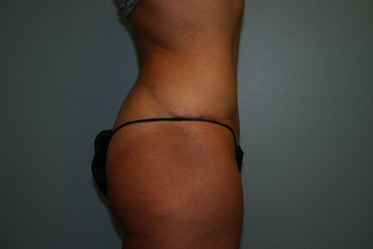 Tummy Tuck Before & After