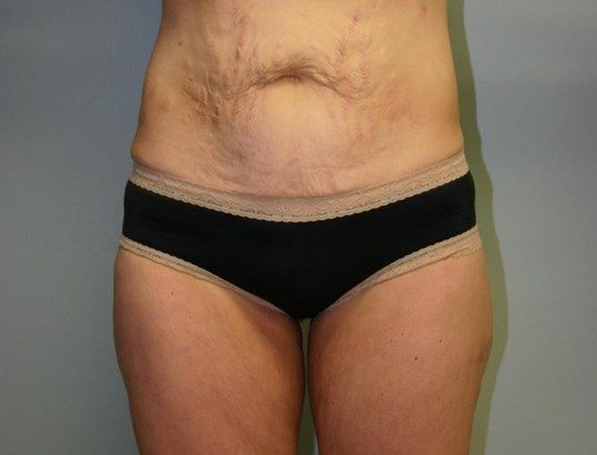 Tummy Tuck Before & After