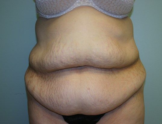 Tummy Tuck Before & After