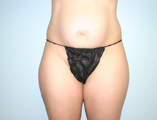 Tummy Tuck Before & After