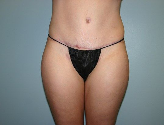 Tummy Tuck Before & After