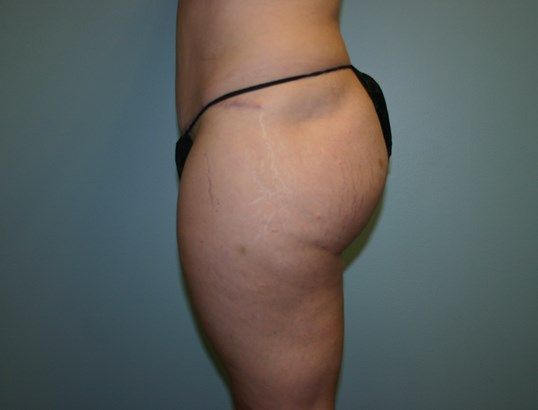 Tummy Tuck Before & After