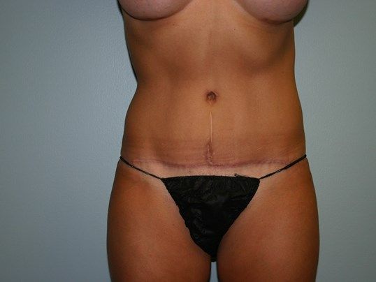 Tummy Tuck Before & After