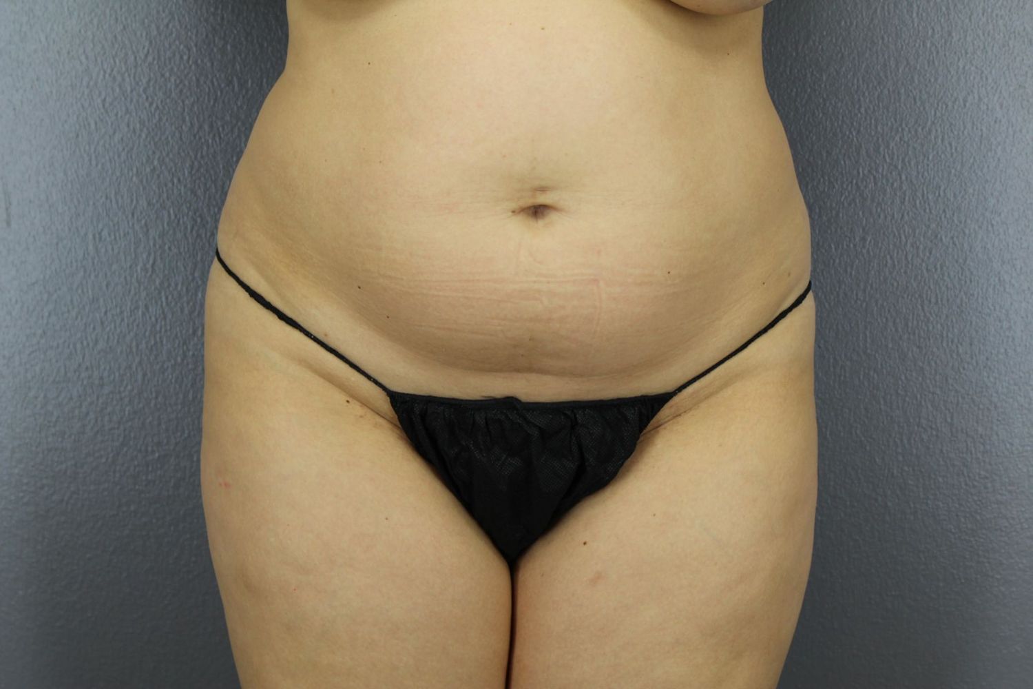 Tummy Tuck Before & After