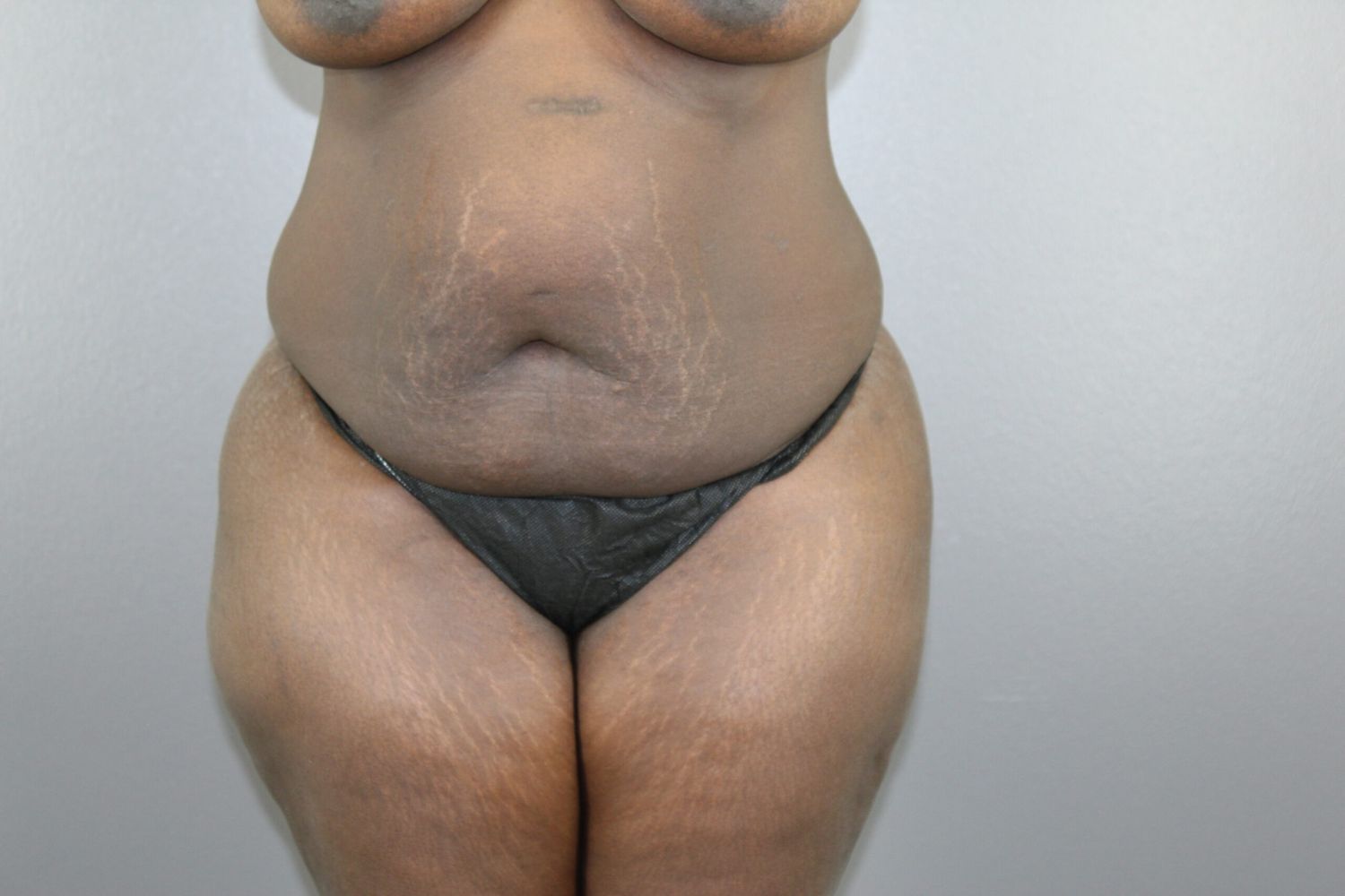 Tummy Tuck Before & After