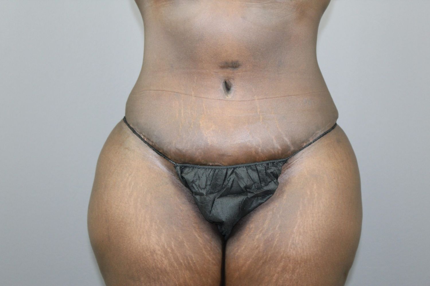 Tummy Tuck Before & After