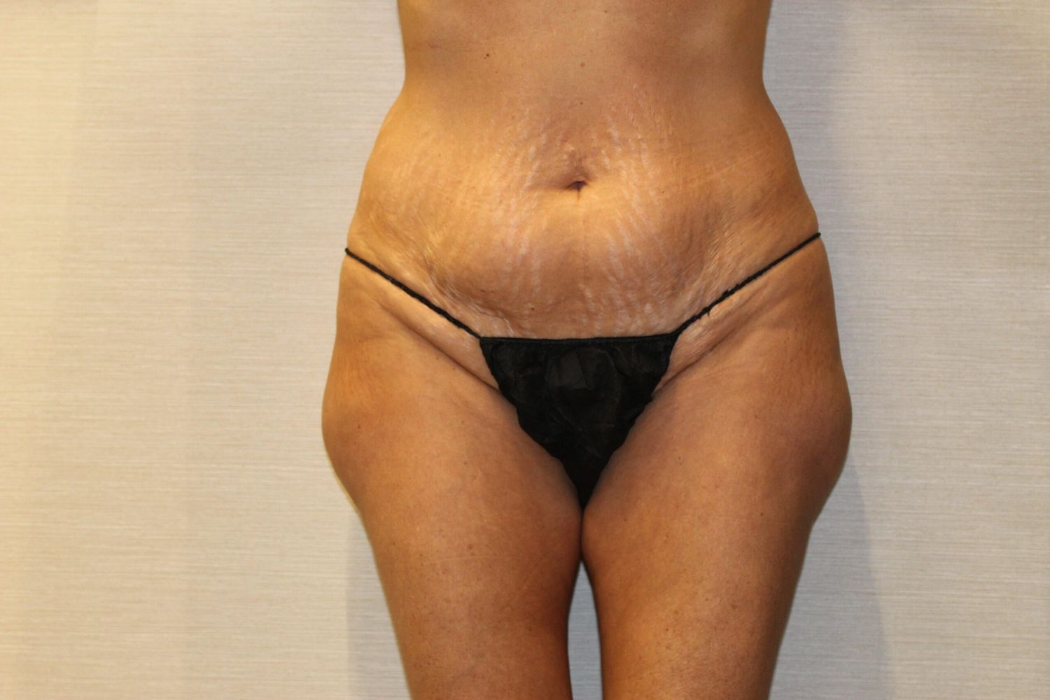 Tummy Tuck Before & After
