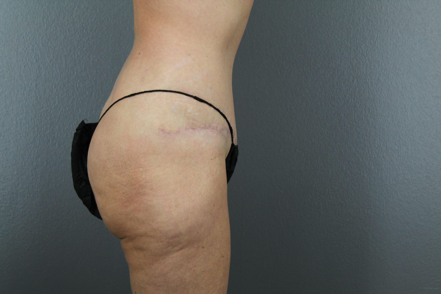 Tummy Tuck Before & After