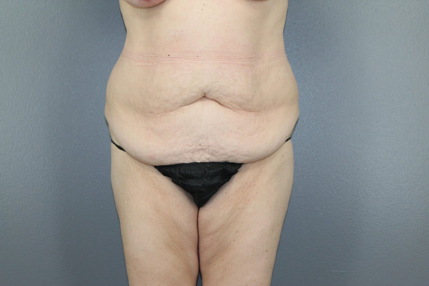 Tummy Tuck Before & After