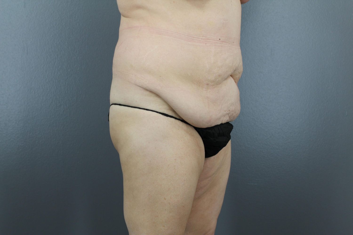 Tummy Tuck Before & After