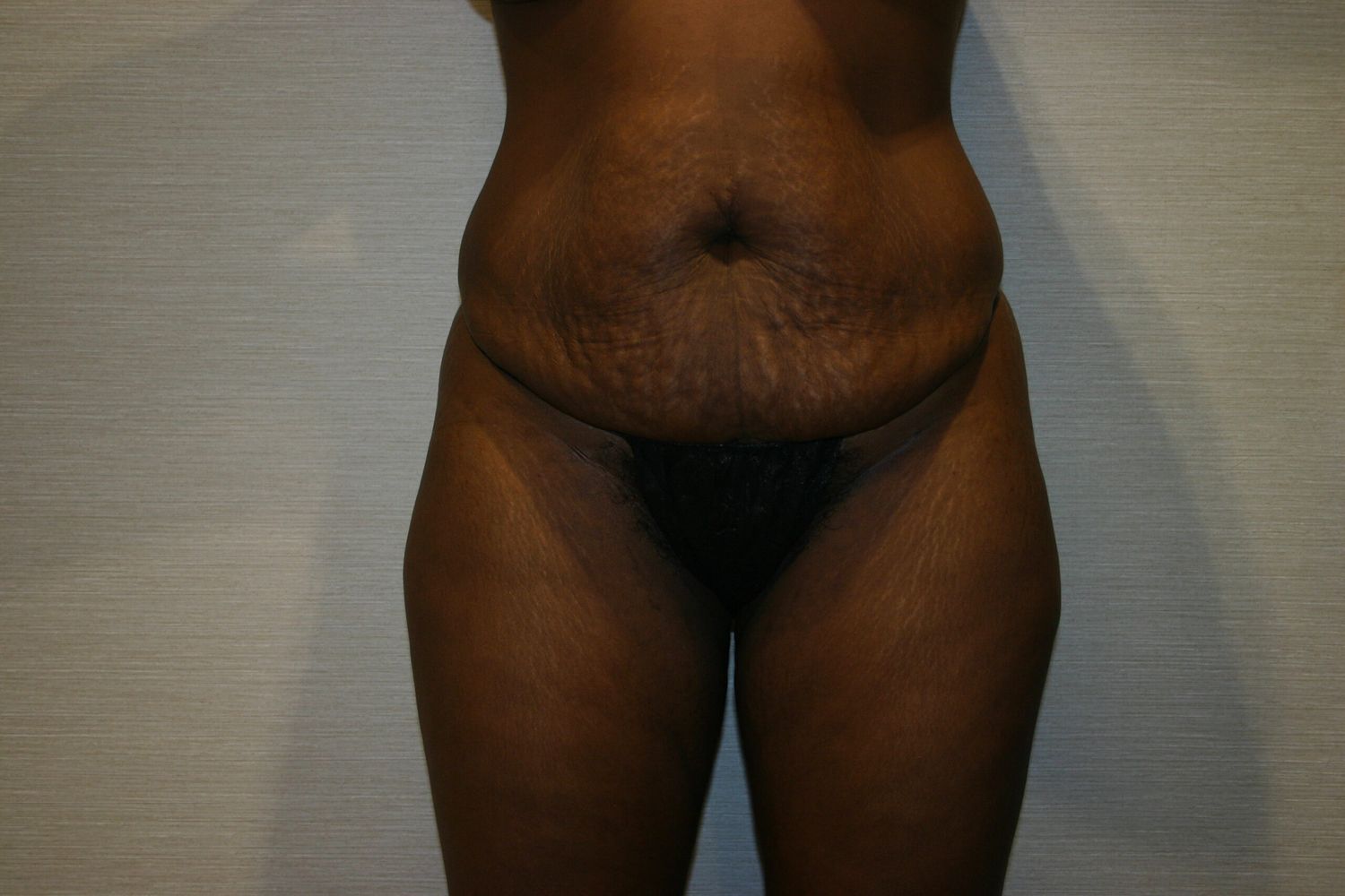 Tummy Tuck Before & After