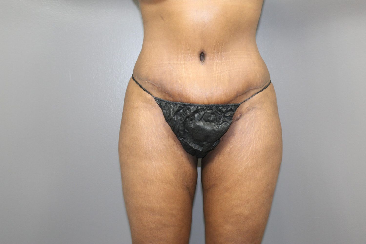 Tummy Tuck Before & After