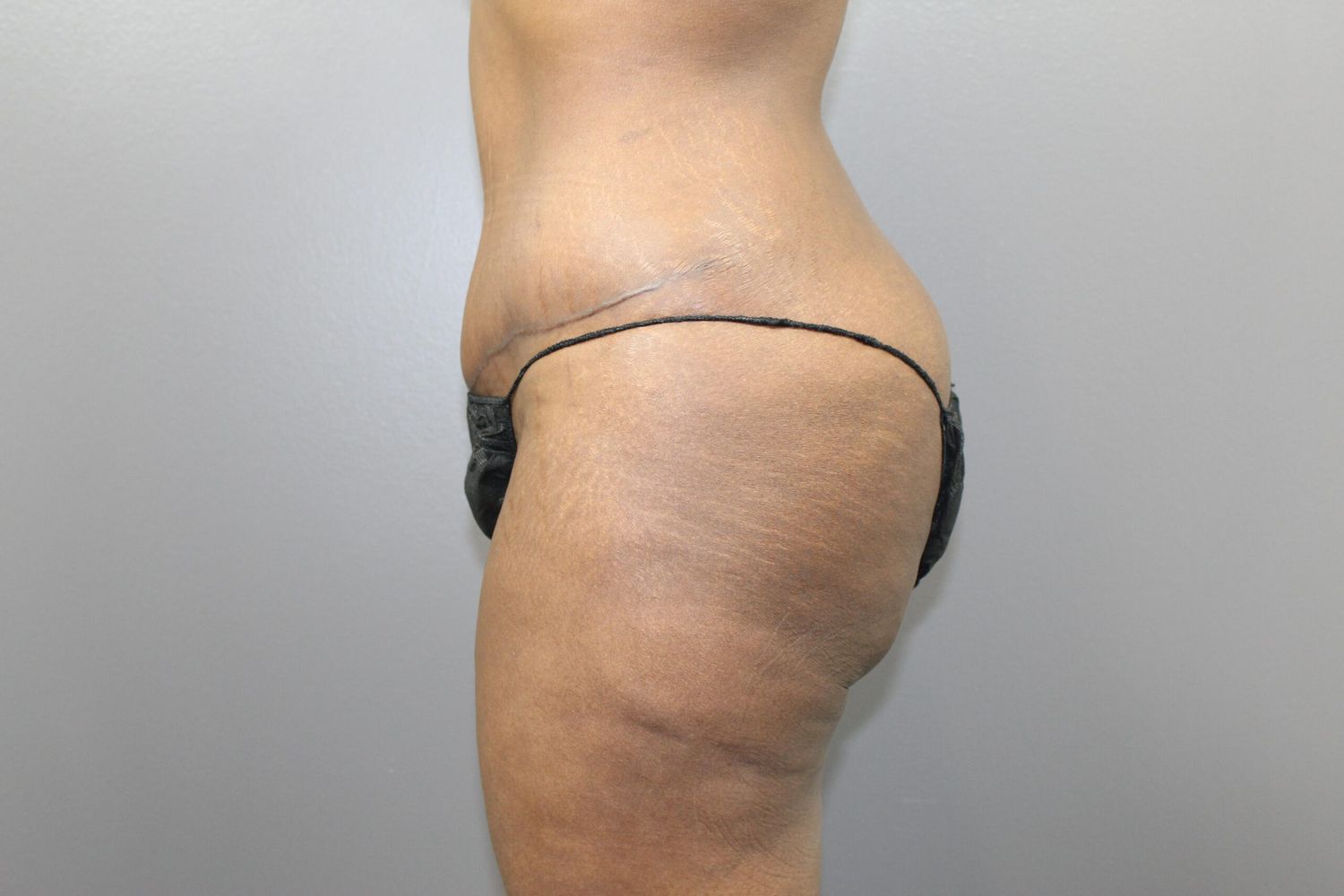 Tummy Tuck Before & After