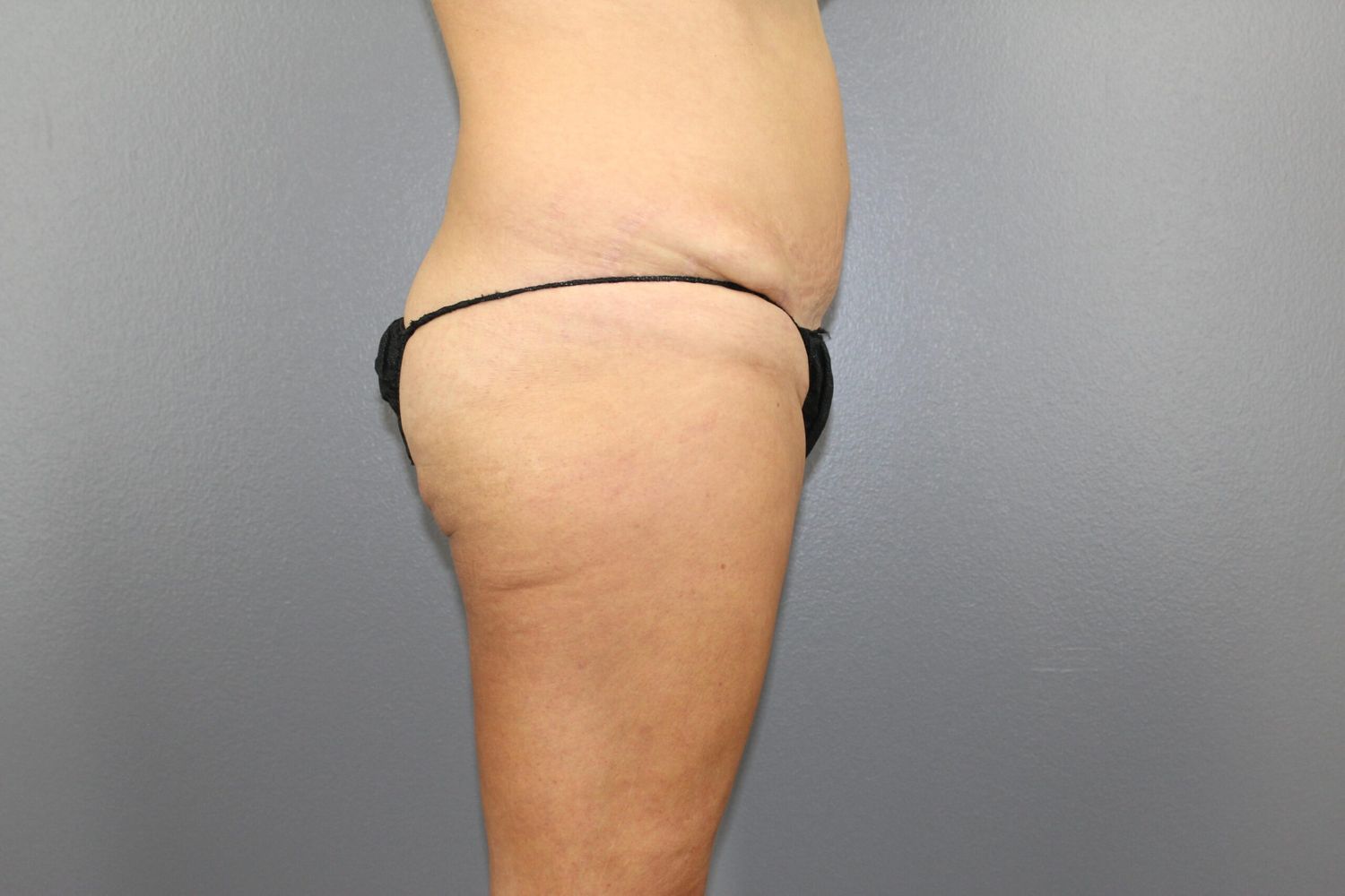 Tummy Tuck Before & After