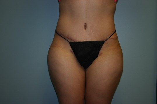 Tummy Tuck Before & After