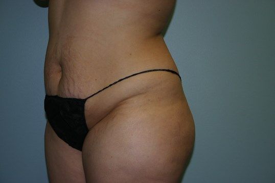 Tummy Tuck Before & After