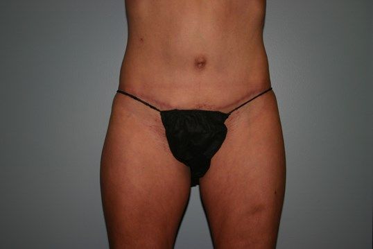 Tummy Tuck Before & After