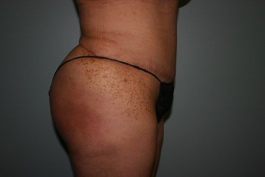 Tummy Tuck Before & After