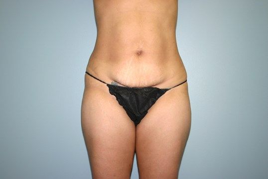 Tummy Tuck Before & After