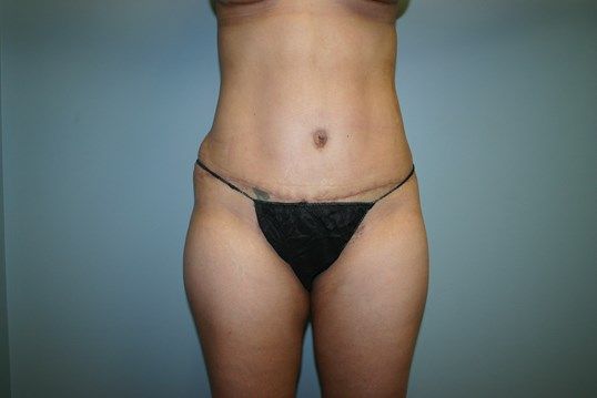 Tummy Tuck Before & After