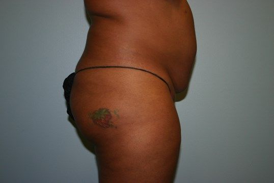 Tummy Tuck Before & After