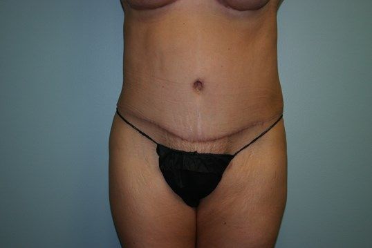 Tummy Tuck Before & After