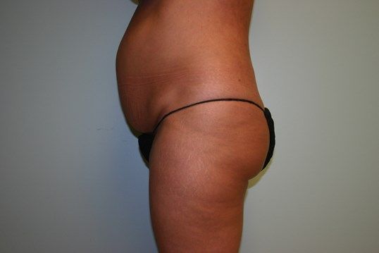 Tummy Tuck Before & After