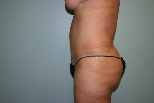 Tummy Tuck Before & After