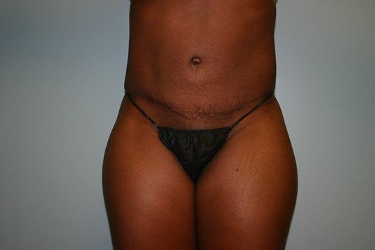 Tummy Tuck Before & After