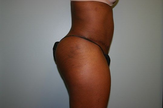 Tummy Tuck Before & After