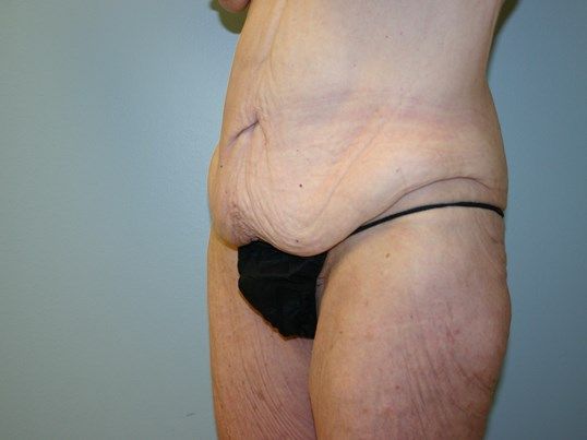 Tummy Tuck Before & After