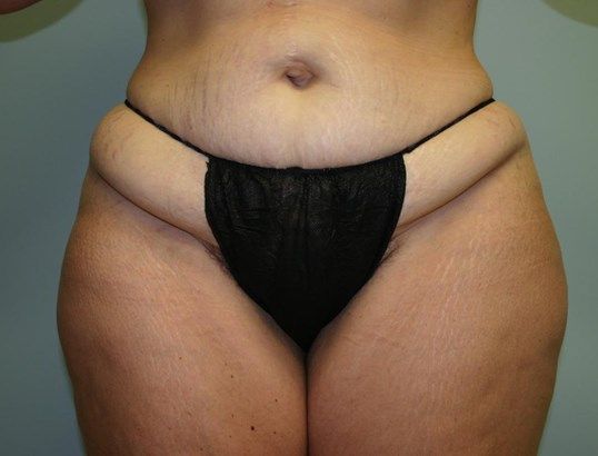 Tummy Tuck Before & After