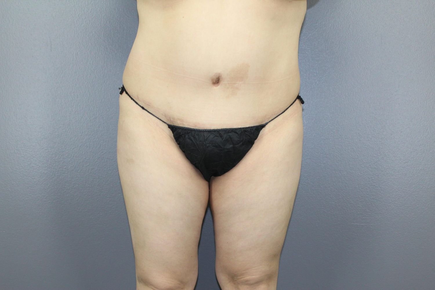 Tummy Tuck Before & After