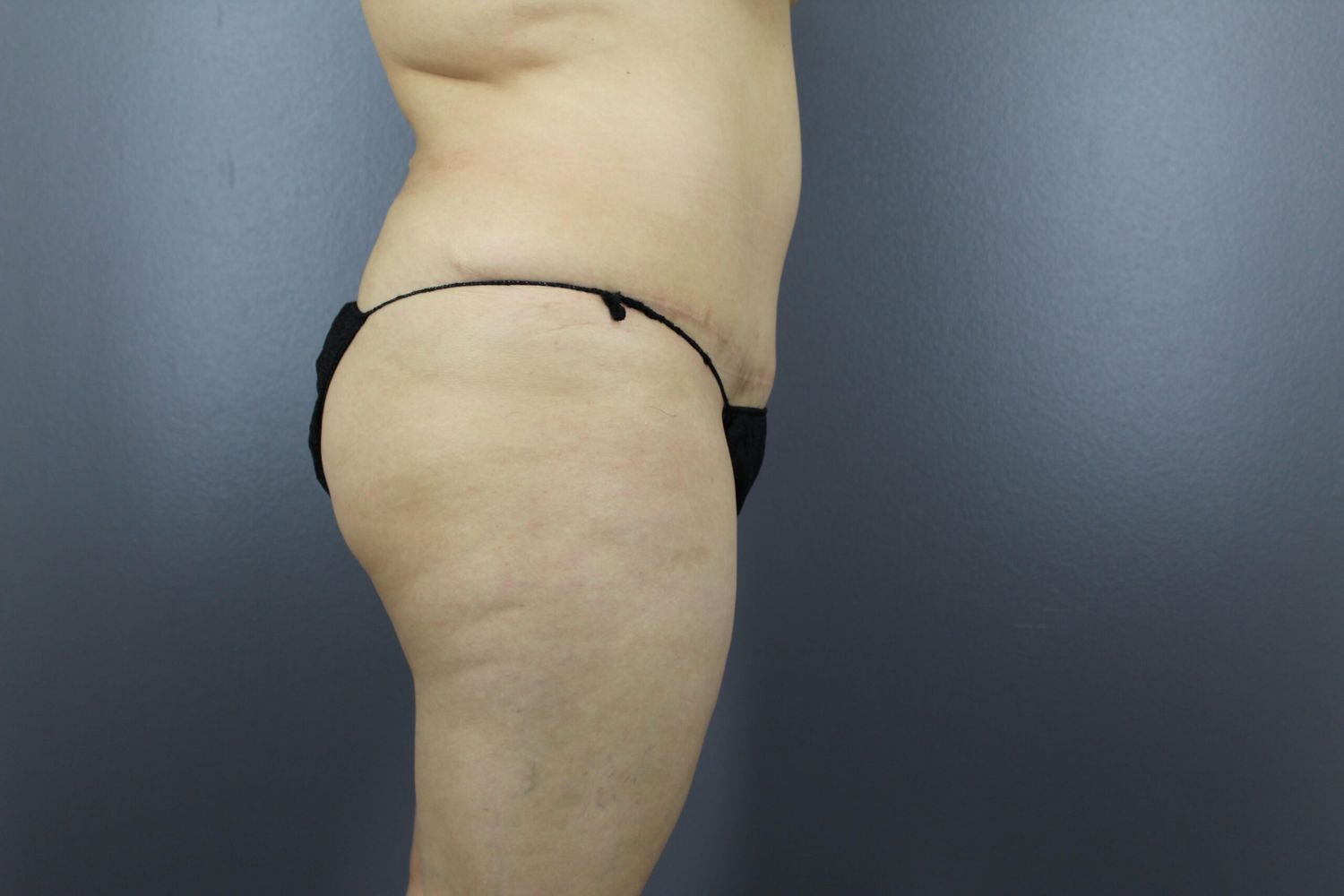 Tummy Tuck Before & After