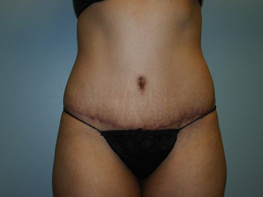 Tummy Tuck Before & After