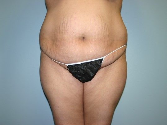 Tummy Tuck Before & After
