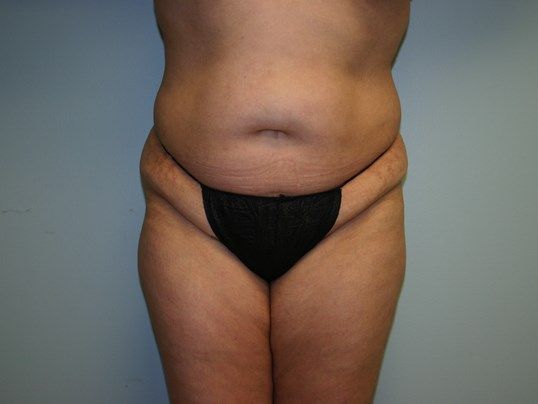 Tummy Tuck Before & After