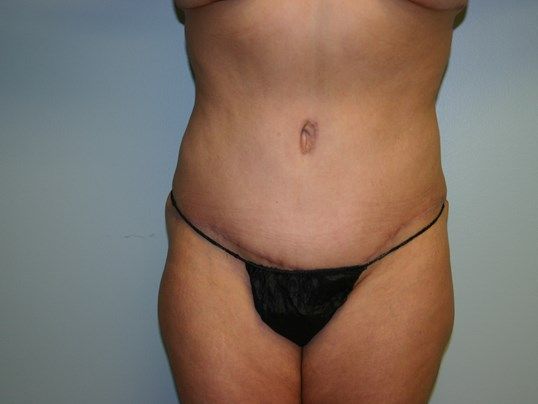 Tummy Tuck Before & After