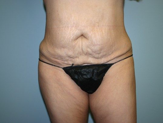 Tummy Tuck Before & After