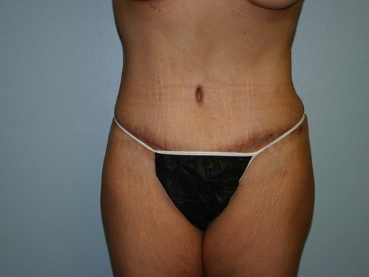 Tummy Tuck Before & After