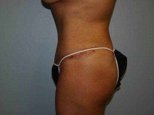 Tummy Tuck Before & After