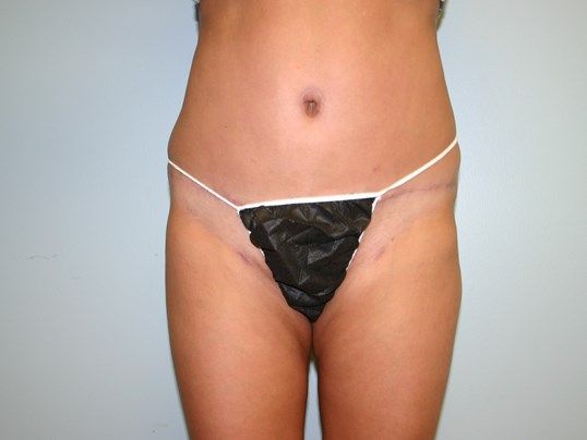 Tummy Tuck Before & After
