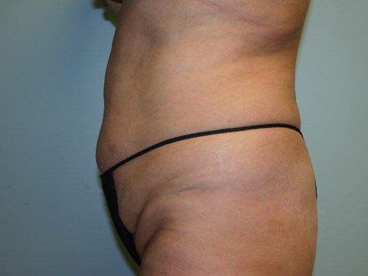 Tummy Tuck Before & After