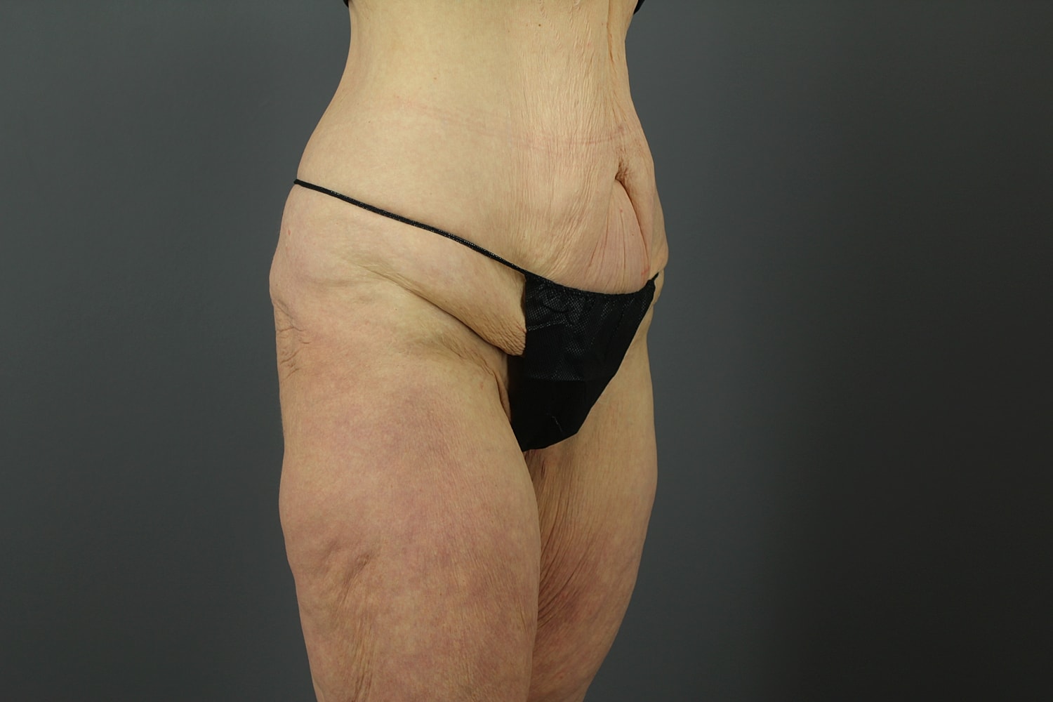 Tummy Tuck Before & After