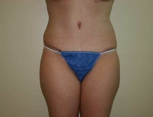 Tummy Tuck Before & After
