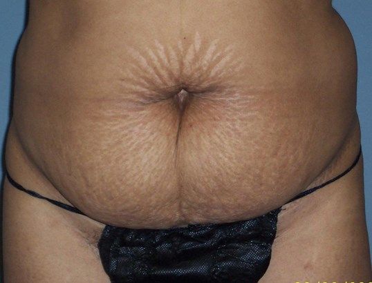 Tummy Tuck Before & After