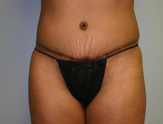 Tummy Tuck Before & After
