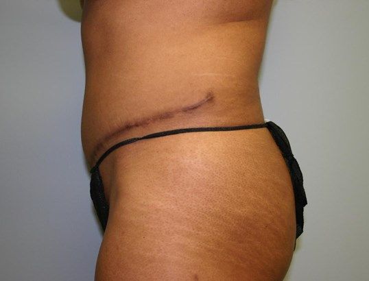 Tummy Tuck Before & After