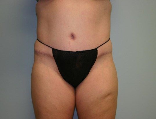 Tummy Tuck Before & After